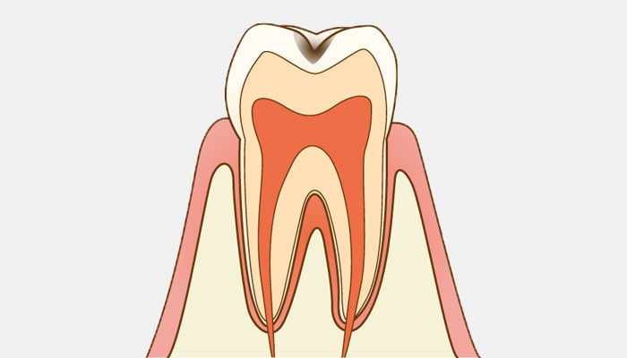 C1：エナメル質の虫歯