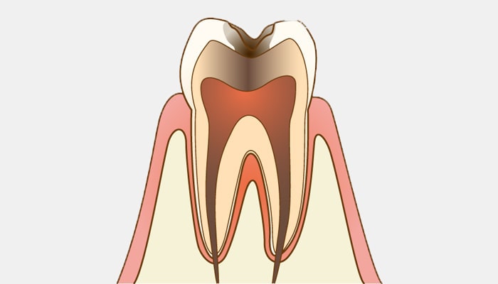 C3：神経まで達した虫歯